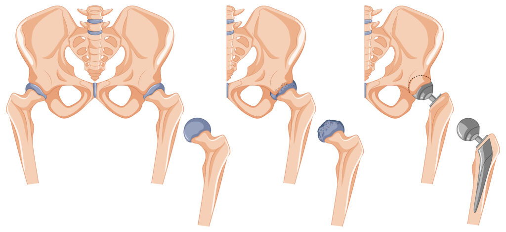 Hip Replacement Surgery in Turkey Cost